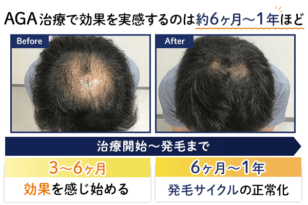 AGA治療で効果を実感するまでの期間を示す画像