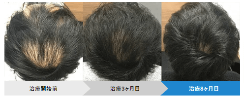 AGAヘアクリニックの症例画像