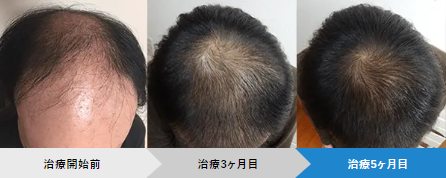 AGAヘアクリニック30代患者の症例写真